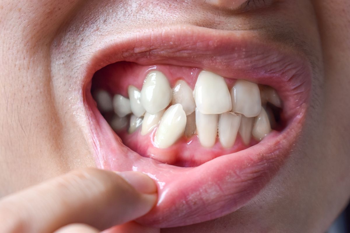 Dents supernumeràries. Problemes que poden causar i tractaments