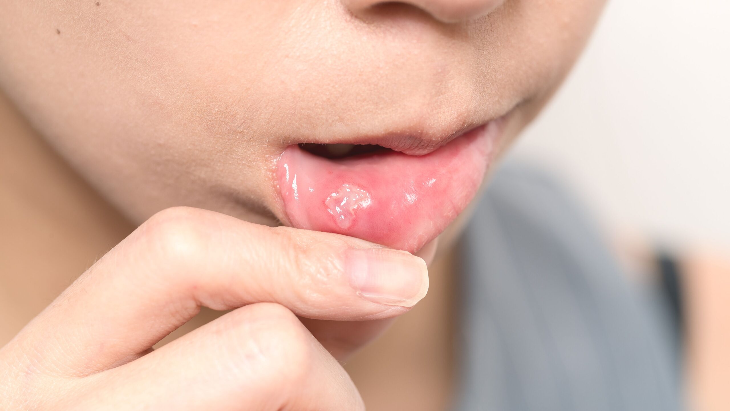 La Estomatitis