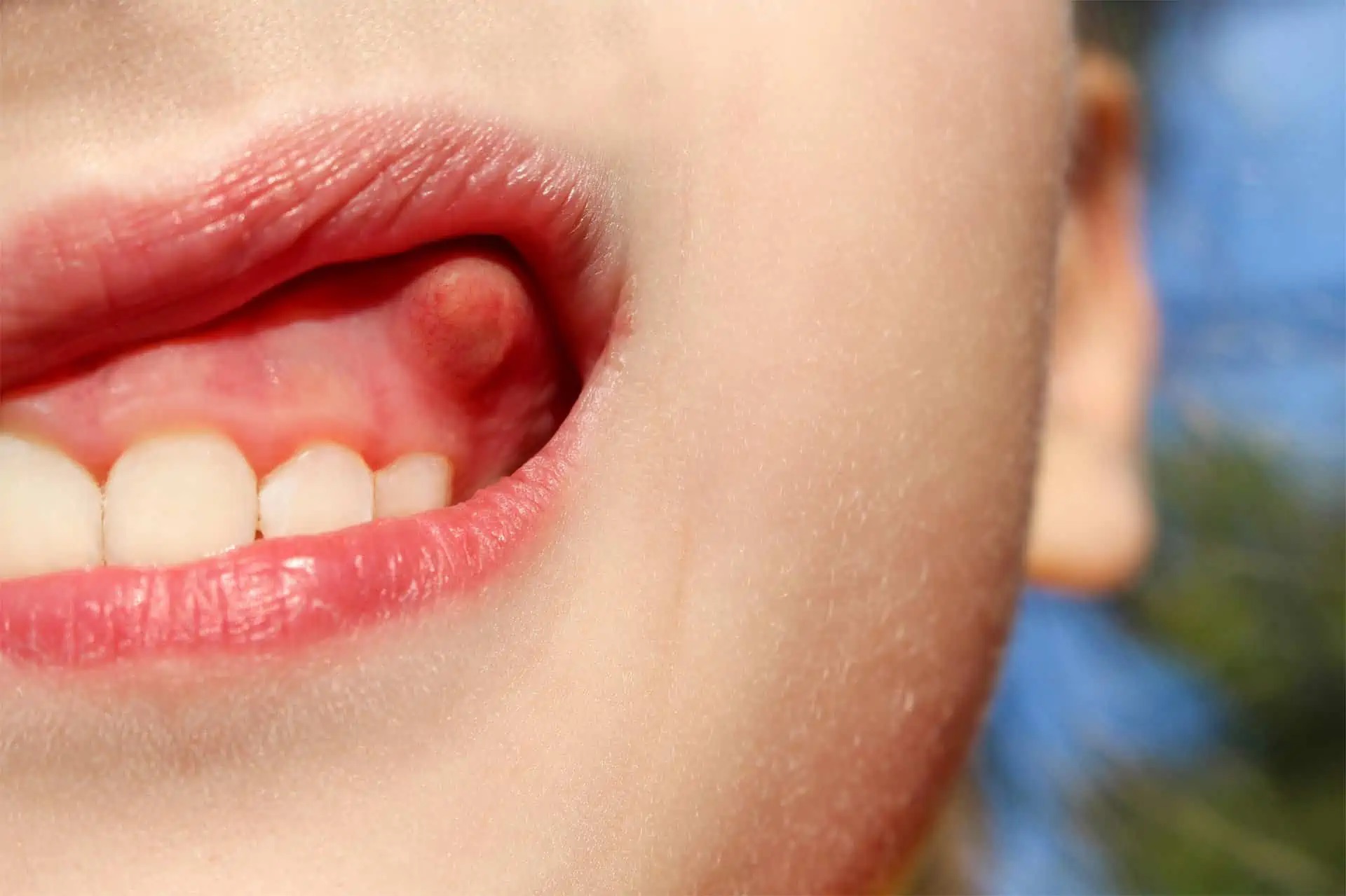 Fístules dentals: causes, símptomes i tractament